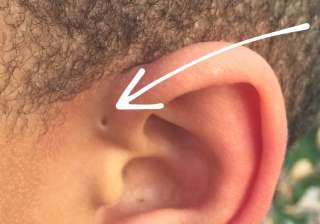 preauricular sinus - India TV preauricular sinus - India TV