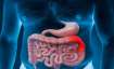 Stomach Cancer