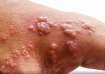 Monkeypox Outbreak