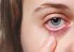 Glaucoma: Warning Signs