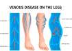 Varicose veins: These unhealthy habits increase your risk
