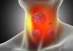 Thyroid Cancer Signs