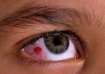 Effective tips to prevent pink eyes during rainy season