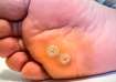 Foot corn can be early sign of diabetes