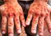 Men are twice as likely as women to develop psoriasis