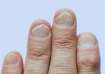 Nail Psoriasis