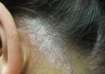 Scalp Psoriasis