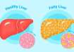 Fatty liver causes several serious health issues