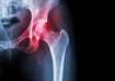 Know types, causes & treatment of hip arthritis