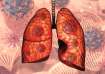 Know importance of early diagnosis for lungs