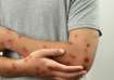 Man from Haryana tests positive for Mpox