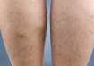 Know causes, symptoms and treatment for varicose veins