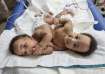 conjoined twins, Amari and Javar Ruffin, at the Children’s Hospital of Philadelphia, March 20, 2024