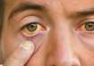 Trachoma