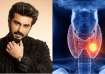 Arjun Kapoor, Hashimoto’s disease