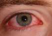 bleeding eye virus