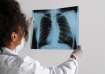 Risk factors for lung cancer and how is it treated