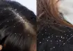 dandruff 