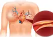 Know what happens to your body when you have high cholesterol