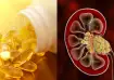 vitamin D supplements and kidney stones