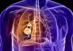 Lung cancer