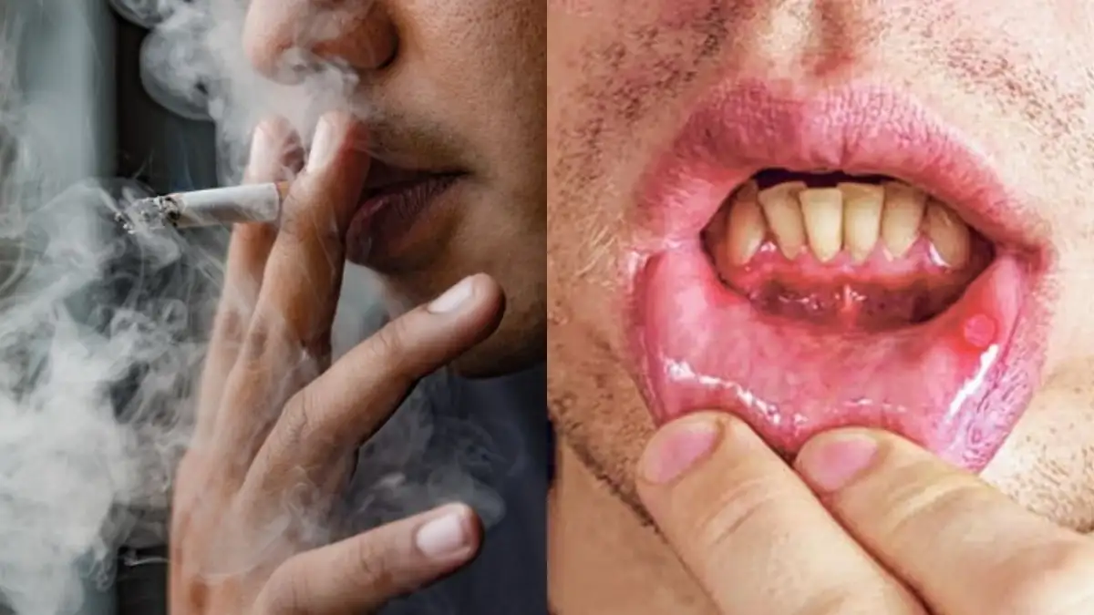Tobacco and Oral Cancer: Expert reveals early signs and ways to prevent  this deadly disease | Health News  India TV