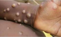 monkeypox, monkeypox virus, belgium, monkeypox, monkeypox cases, monkeypox in europe, monkeypox live