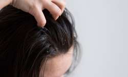 Dandruff: here are easy home remedies 