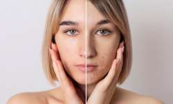 scars and acne marks