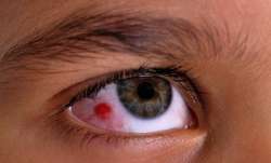 Effective tips to prevent pink eyes during rainy season
