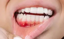 mouth ulcers