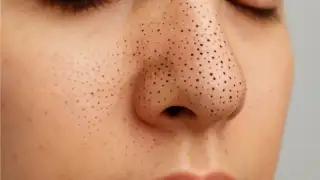 blackheads and pimples