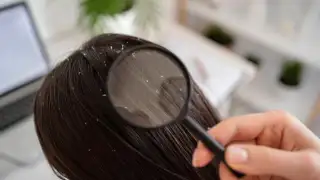 Winter dandruff triggers nobody talks about