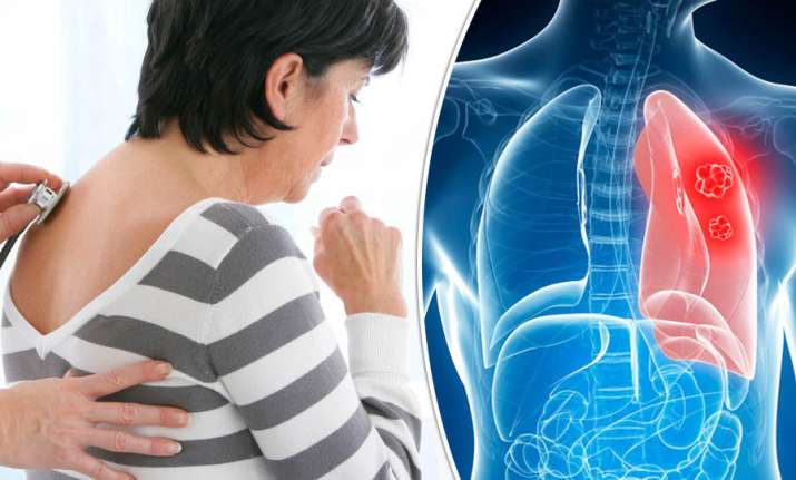 Lung cancer: Symptoms, causes, treatment of this life-threatening ...