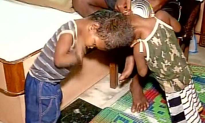 AIIMS doctors successfully separate conjoined twins from