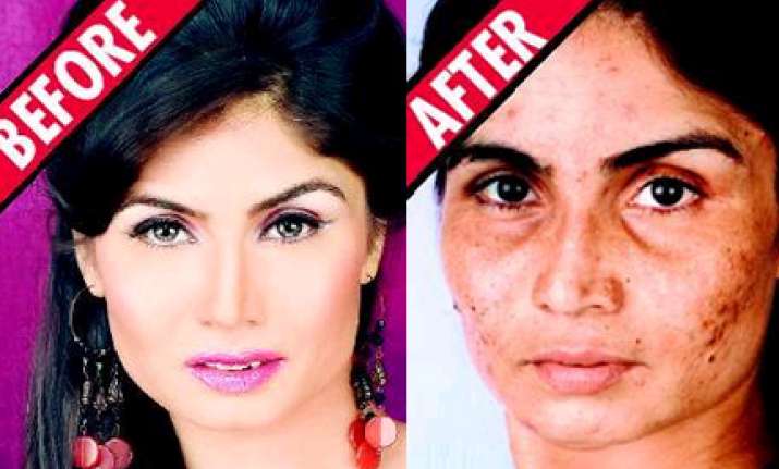 shilpa in a soup over botched skin treatment