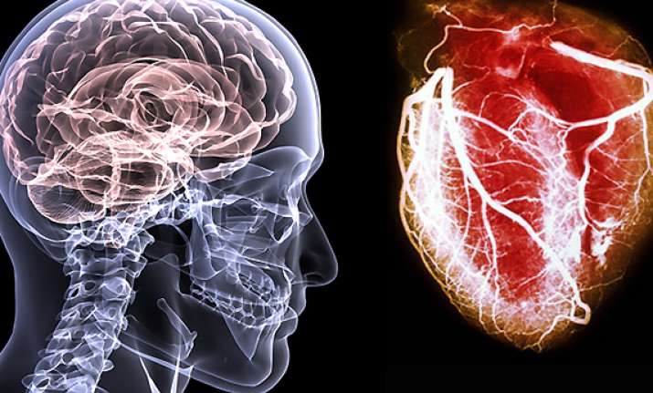 brain attacks as serious as heart attacks expert