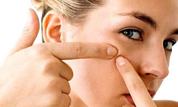 tips to avoid acne rashes in summer