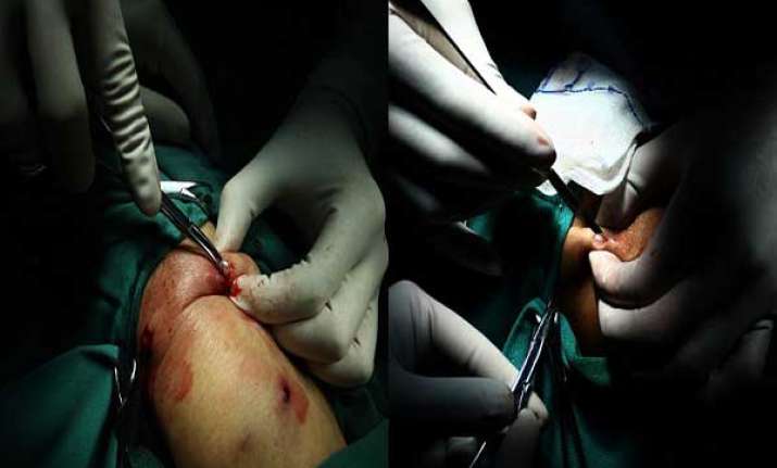bizzare 42 pearls extracted from chinese man s body watch