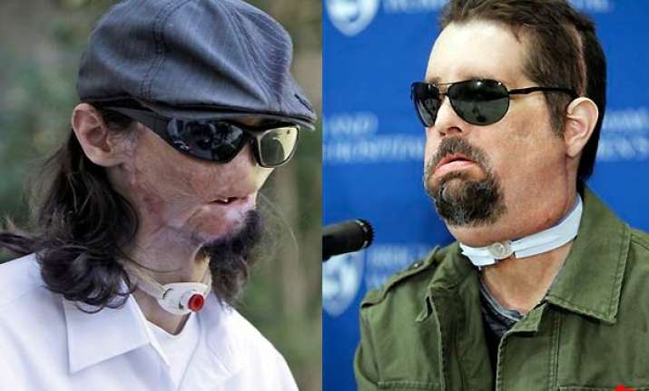 first full face transplant in us
