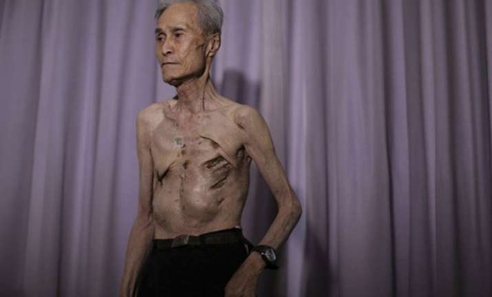 in pics nagasaki atomic bomb survivor shows his scars