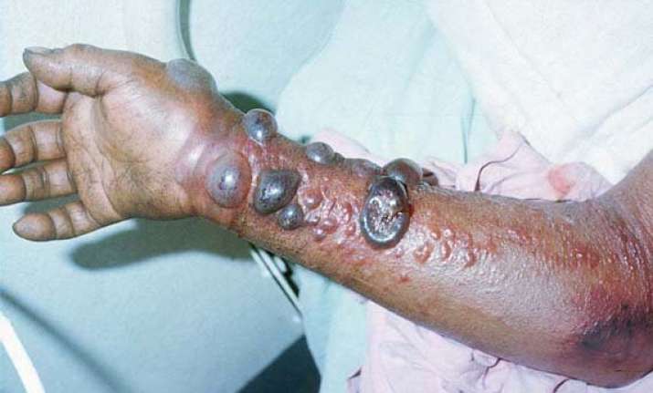 mathematics behind ebola epidemic decoded