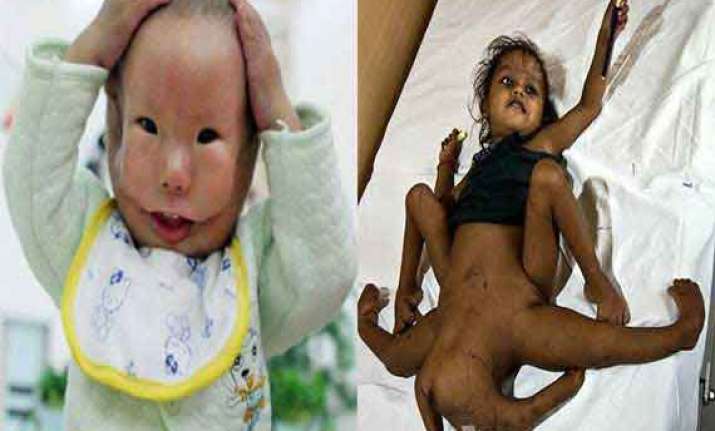 know people who have extra body parts