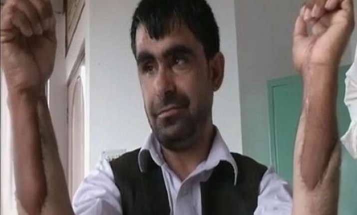 afghan military captain gets indian hands in transplant