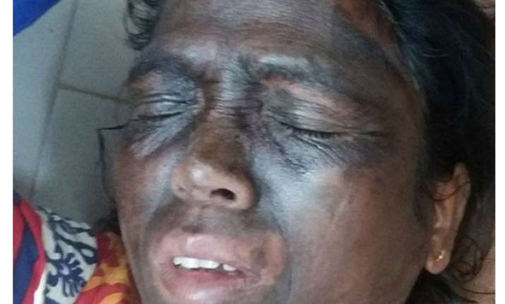 acid like substance rubbed on tribal activist soni sori s