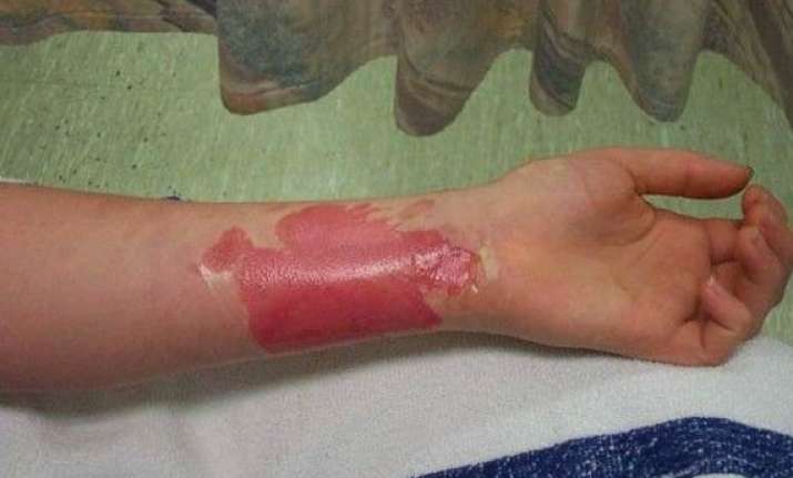 indian burn indian burn