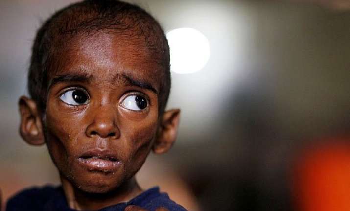 why malnutrition remains a challenge for india