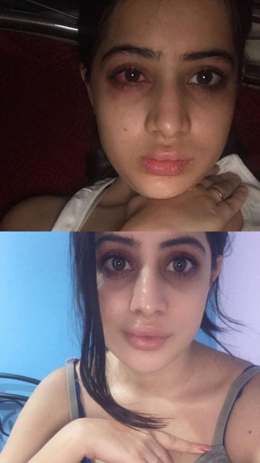 Urfi Javed's painful journey of getting lip &amp; undereye fillers