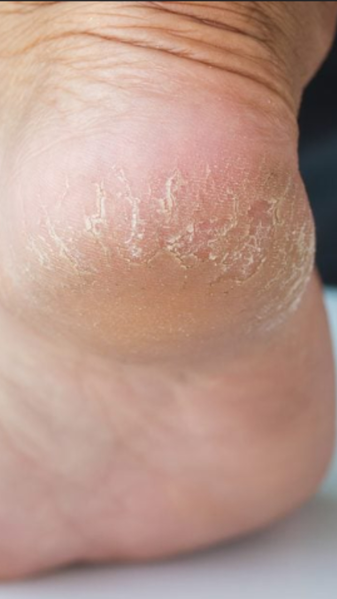 6 lesser-known remedies to heal cracked heels during winter