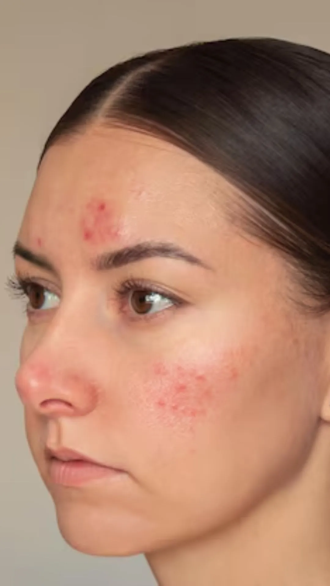 7 ways to treat acne from the root naturally